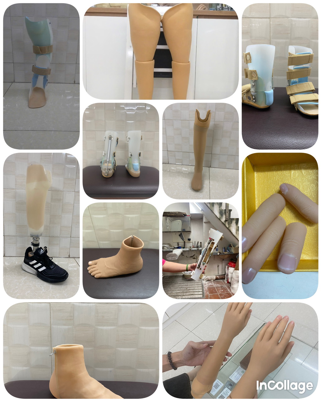 Chi phí điều trị chấn thương bằng dụng cụ chỉnh hình