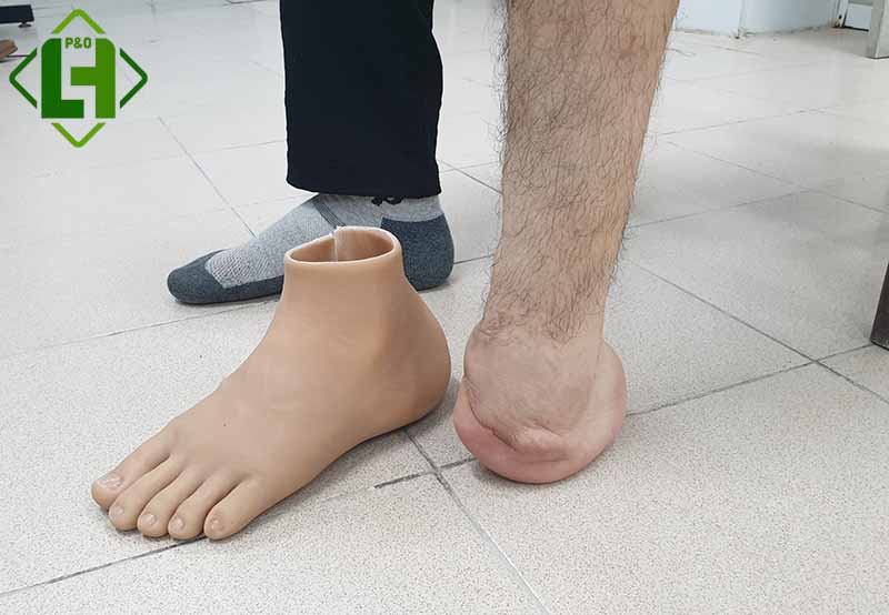 踝关节离断假肢的装配