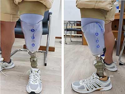 Công Nghệ Thiết Kế Socket Cho Chân Giả: Nền Tảng Của Một Chân Giả Hiệu Quả