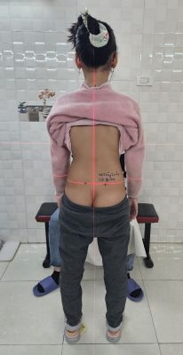 足部矫形器（FO）：扁平足与足部畸形的矫正方案