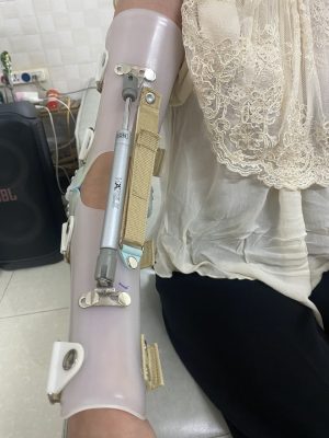 腕手矫形器（WHO）：辅助手部与腕部康复