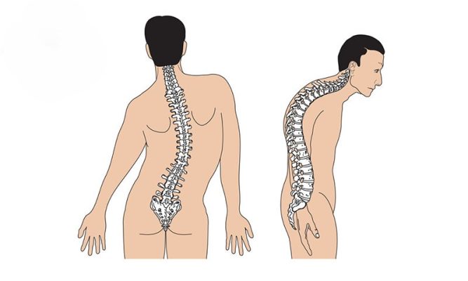 Phương pháp sử dụng áo nẹp chỉnh hình điều trị cong vẹo cột sống